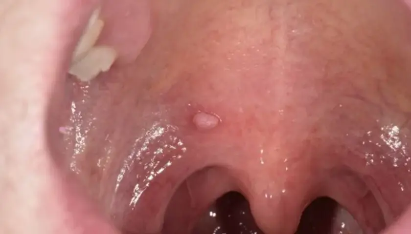 Objawy HPV w jamie ustnej: ciche sygnały, które ratują życie