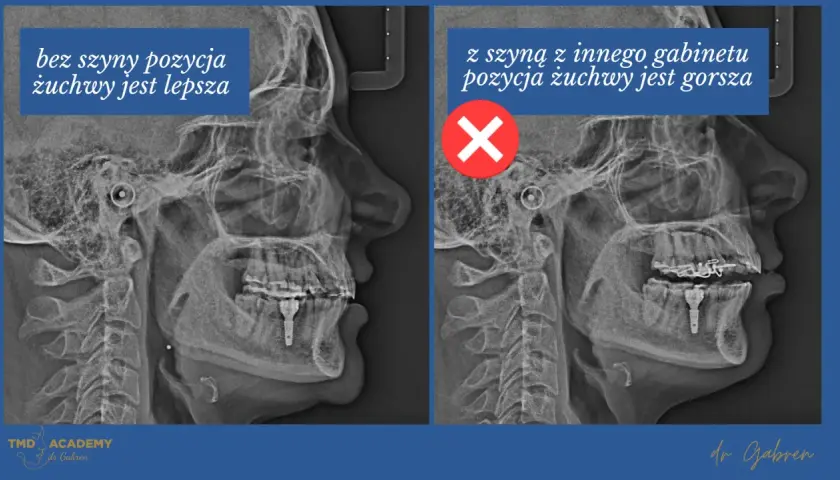 Rentgen żuchwy: po lewej bez szyny Michigan, pozycja lepsza. Po prawej z szyną, pozycja gorsza.