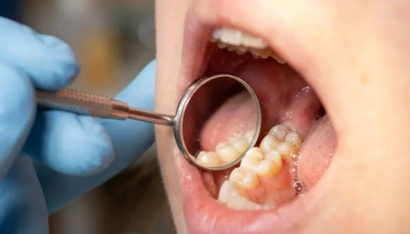 Dentysta bada zęby, szukając oznak infiltracji próchnicy. Widoczne są zęby i lusterko dentystyczne.
