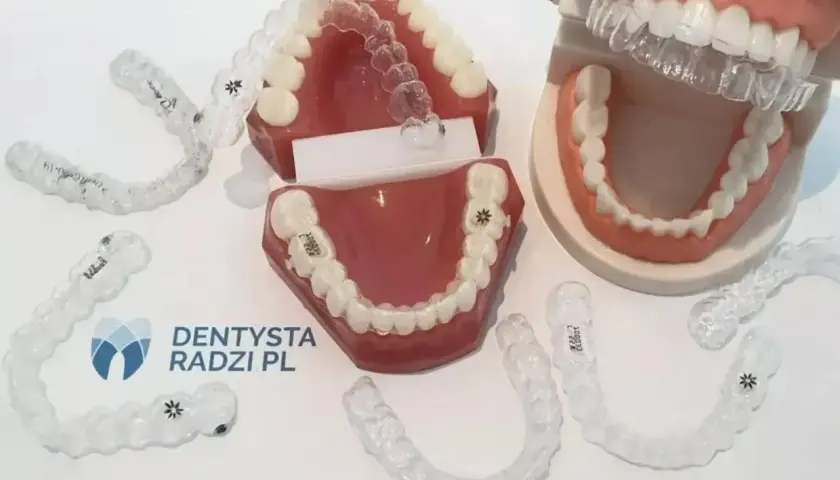 Modele szczęk z nakładkami ortodontycznymi. Zastanawiasz się, po jakim czasie widać pierwsze efekty aparatu ortodontycznego?