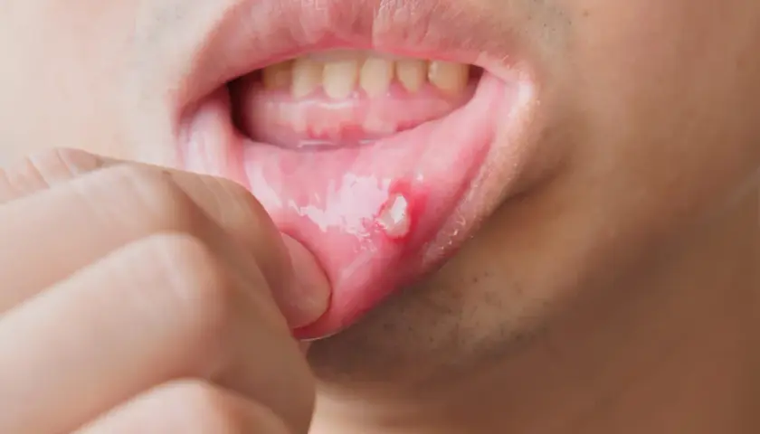 Masz opryszczkę? Dentysta odmówi! Co robić i kiedy iść?