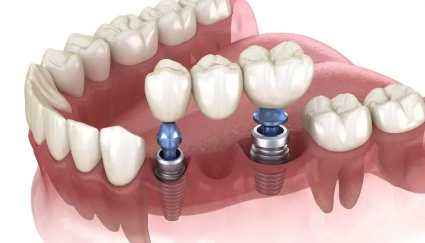 Koszt implantu zęba w Polsce: Pełna cena i co wpływa na nią?