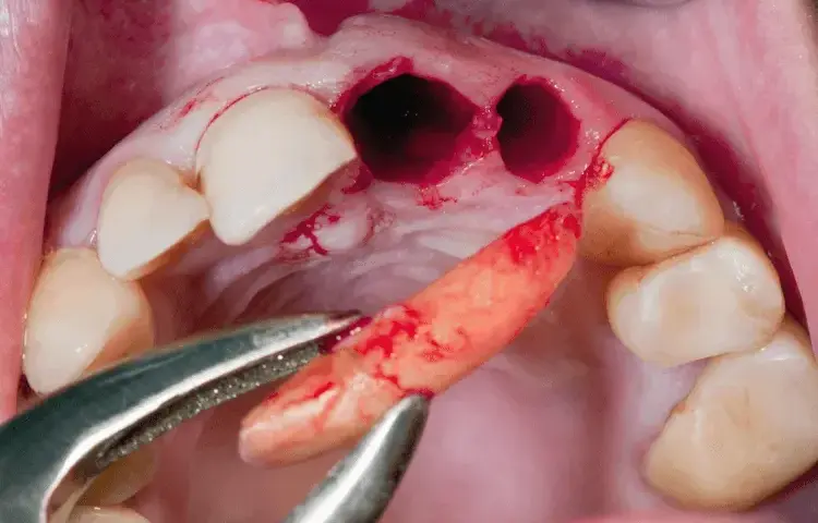 Palenie po dentyście: Suchy zębodół, implanty. Jak długo czekać?