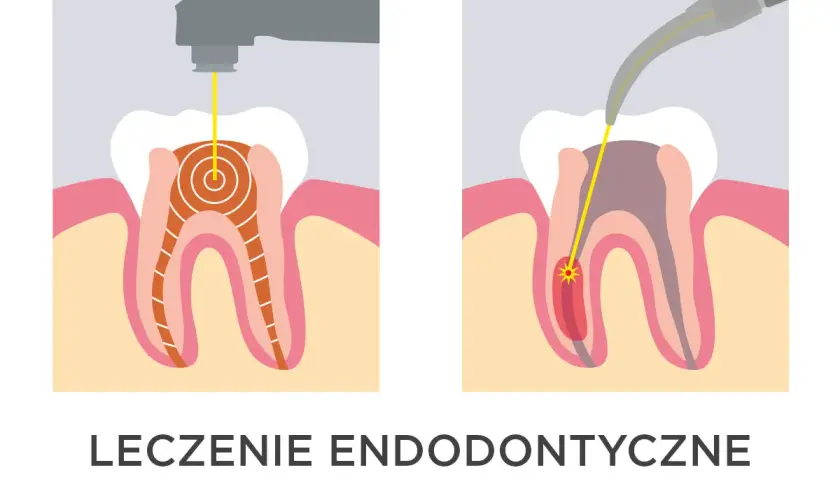 Ilustracja pokazuje laserowe leczenie zębów. Dwa etapy endodoncji z użyciem lasera, który precyzyjnie dociera do wnętrza zęba.
