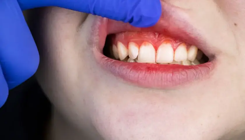 Ból dziąseł: co ci mówią? Przyczyny, leczenie i kiedy do dentysty