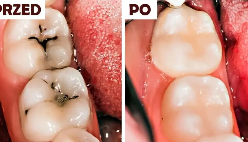 Domowe sposoby na próchnicę: co działa, a kiedy musisz iść do dentysty?