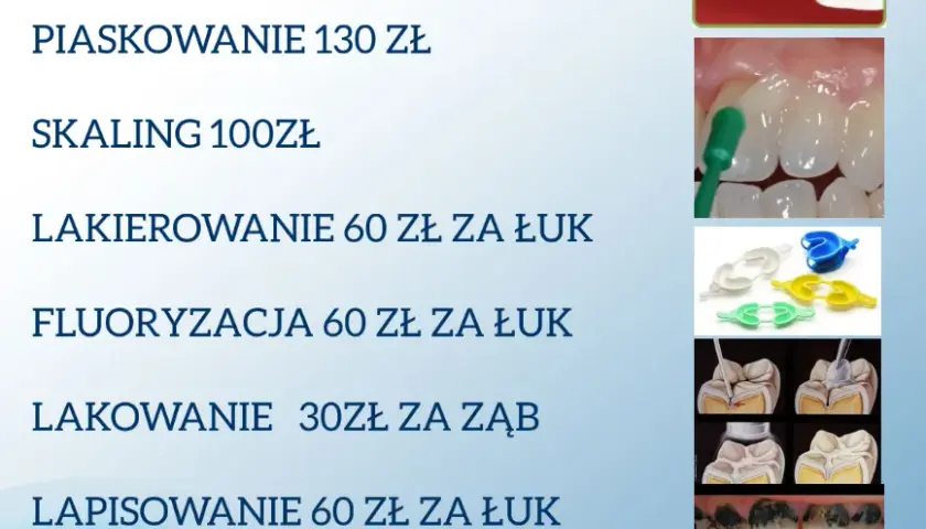 Koszt leczenia kanałowego zęba: Ceny, NFZ, na co uważać?
