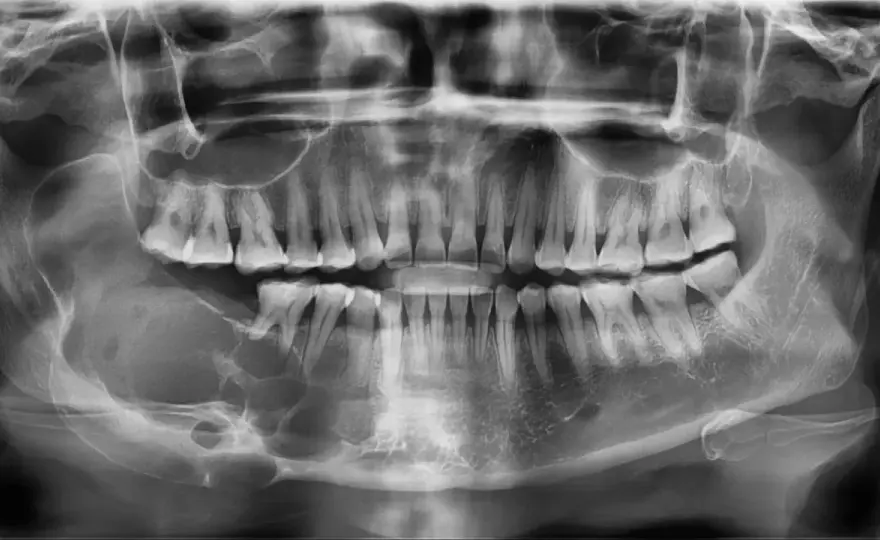 Szkliwiak żuchwy (ameloblastoma) - objawy i leczenie