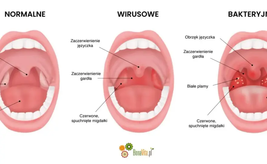 Afta w gardle? Jak odróżnić ją od anginy i co pomaga