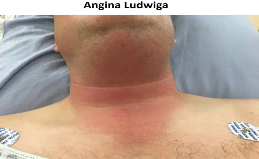 Angina Ludwiga - objawy, przyczyny i leczenie w szpitalu