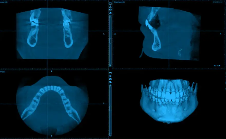 CBCT zębów - kiedy jest potrzebne i ile kosztuje?