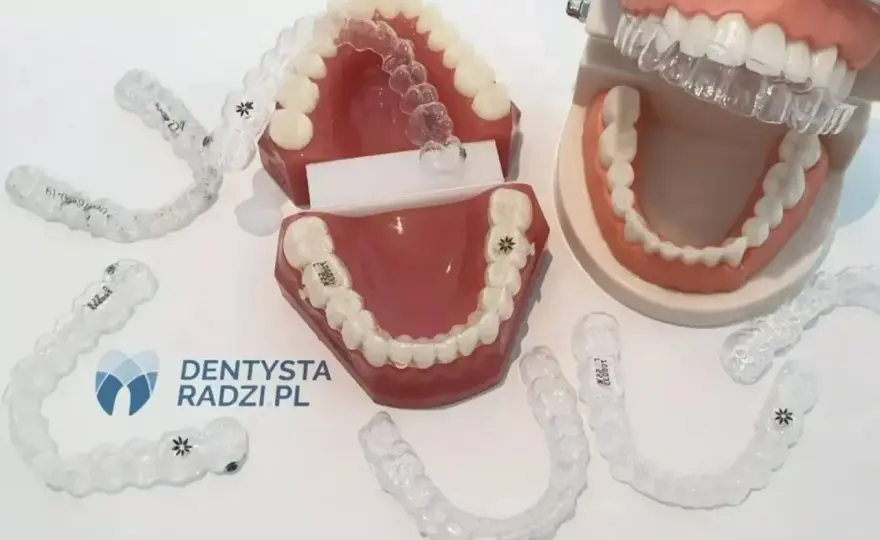 Pierwsze efekty aparatu ortodontycznego - kiedy je zobaczysz?