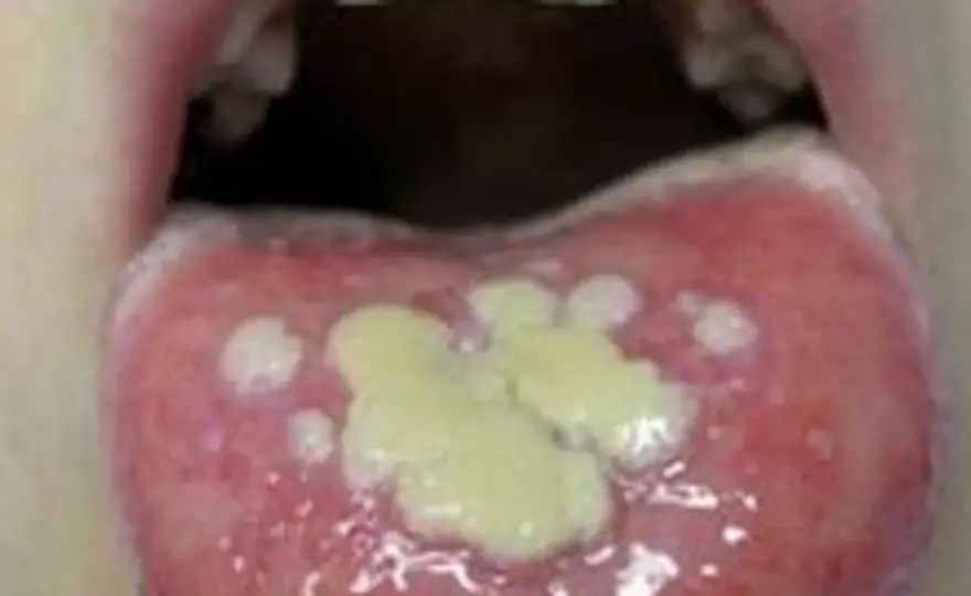 Afta na języku - co pomaga i kiedy do dentysty?