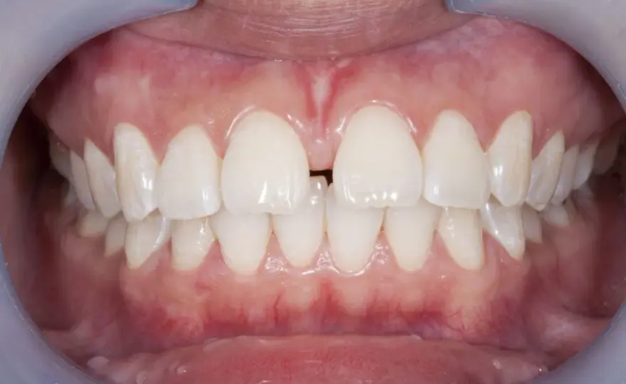 Diastema - leczyć czy obserwować? Poznaj prawdę!