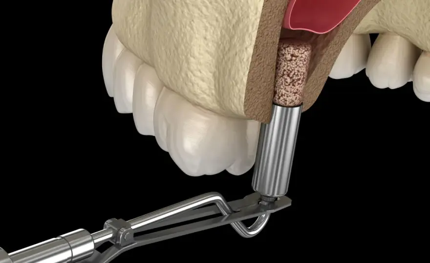 Dno zatoki szczękowej a zęby - kiedy potrzebny jest sinus lift?