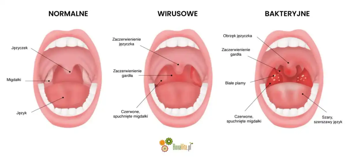 Afta w gardle? Jak odróżnić ją od anginy i co pomaga