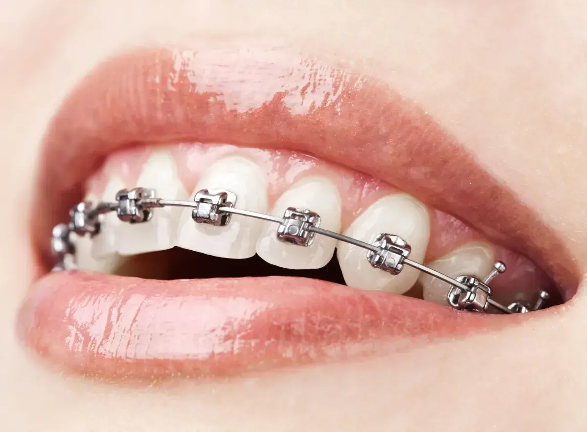 Zbliżenie na usta z aparatem ortodontycznym na zębach.