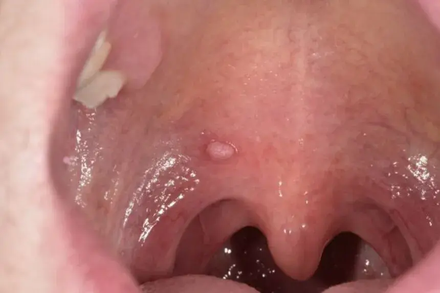 Objawy HPV w jamie ustnej: ciche sygnały, które ratują życie