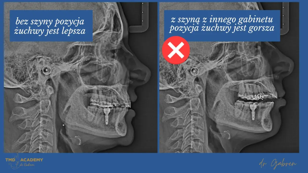 Rentgen żuchwy: po lewej bez szyny Michigan, pozycja lepsza. Po prawej z szyną, pozycja gorsza.