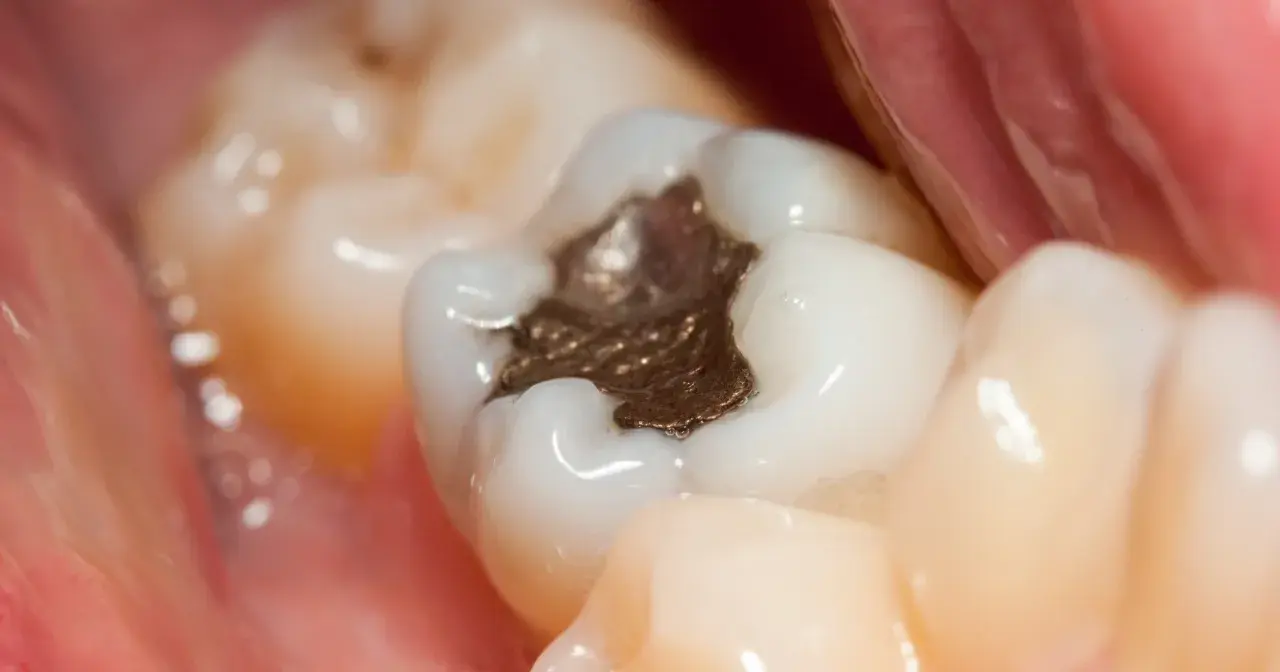 Widok zęba z widoczną, ciemną, metaliczną plombą, otoczoną białymi zębami i różowymi tkankami jamy ustnej.