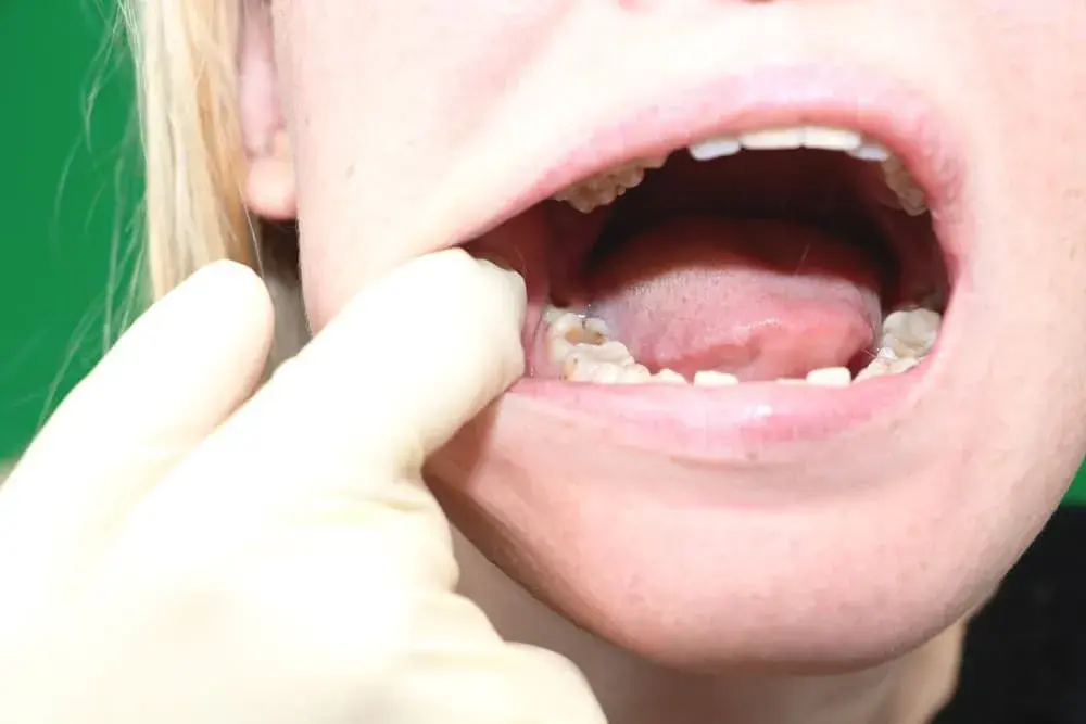 Ból zęba mądrości (ósemki): Szybka ulga i kiedy do dentysty?