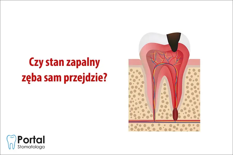 Stan zapalny zęba: Objawy, leczenie, koszty. Czy da się go uniknąć?