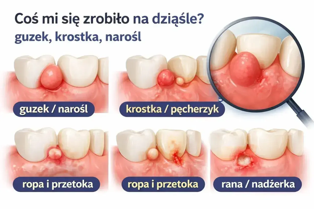 Guzek, krostka, przetoka na dziąśle – objawy mogą być różne, ale często towarzyszy im ćmiący ból zęba. Ilustracja pokazuje zmiany przy zębach.