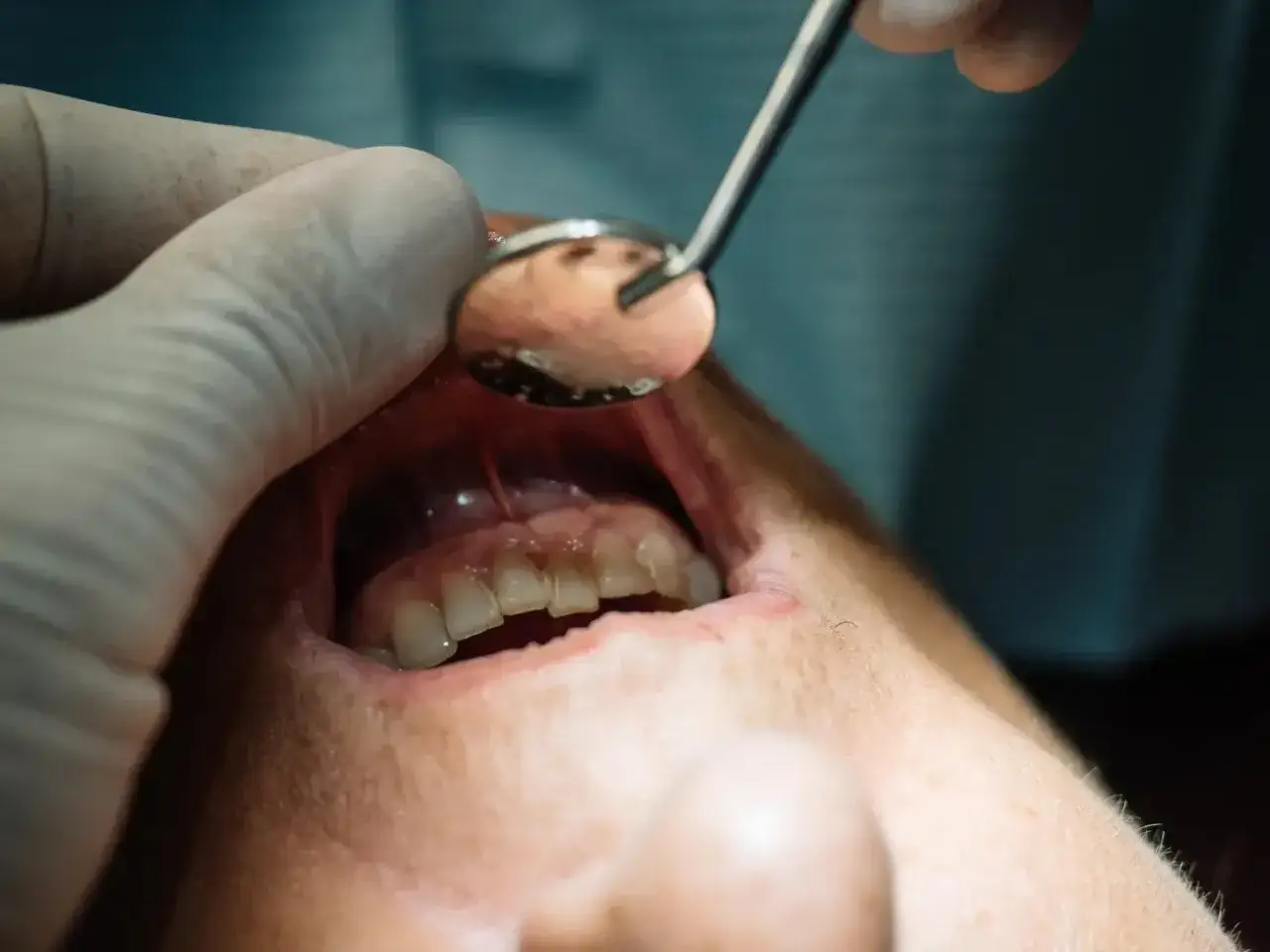 dentysta konsultacja ból zęba ropa