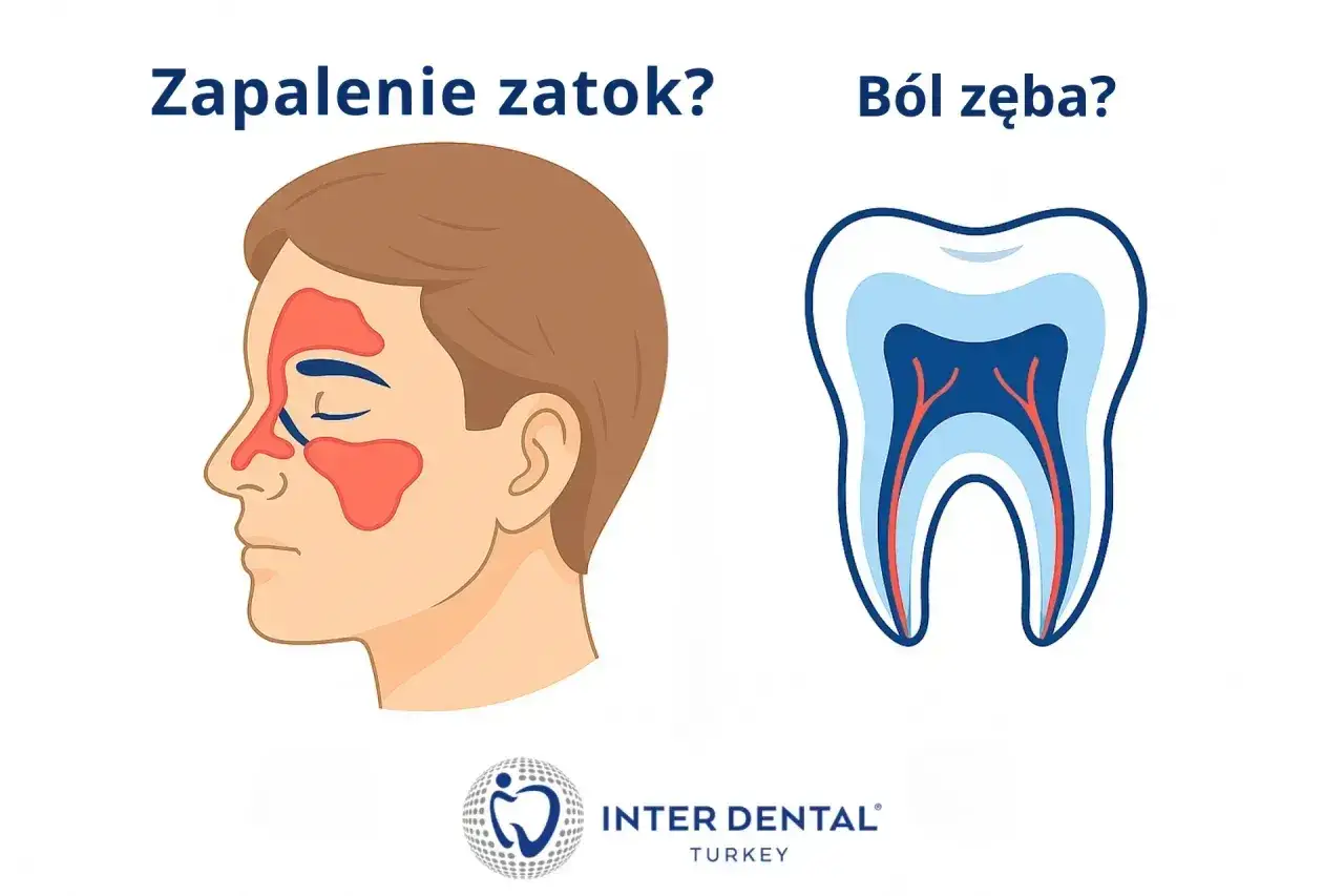 Zapalenie zatok czy ból zęba przy dotyku? Ilustracja porównuje objawy zapalenia zatok z budową zęba.