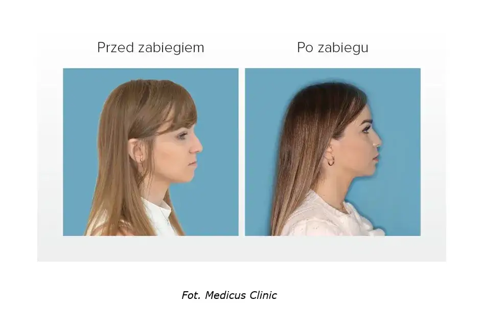 nieprawidłowy zgryz konsekwencje