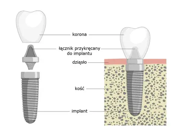 schemat budowy implantu zębowego