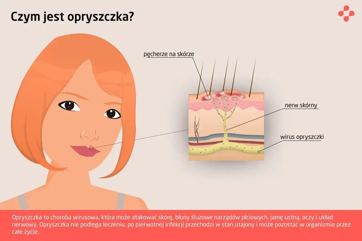 opryszczka wargowa wirus przenoszenie