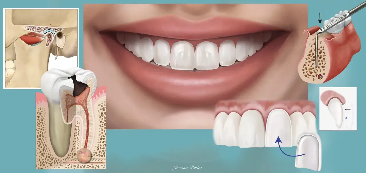 Ilustracja przedstawia anatomię szczęki, próchnicę, implant dentystyczny i licówki. Duże zęby są kluczowe dla zdrowego uśmiechu.