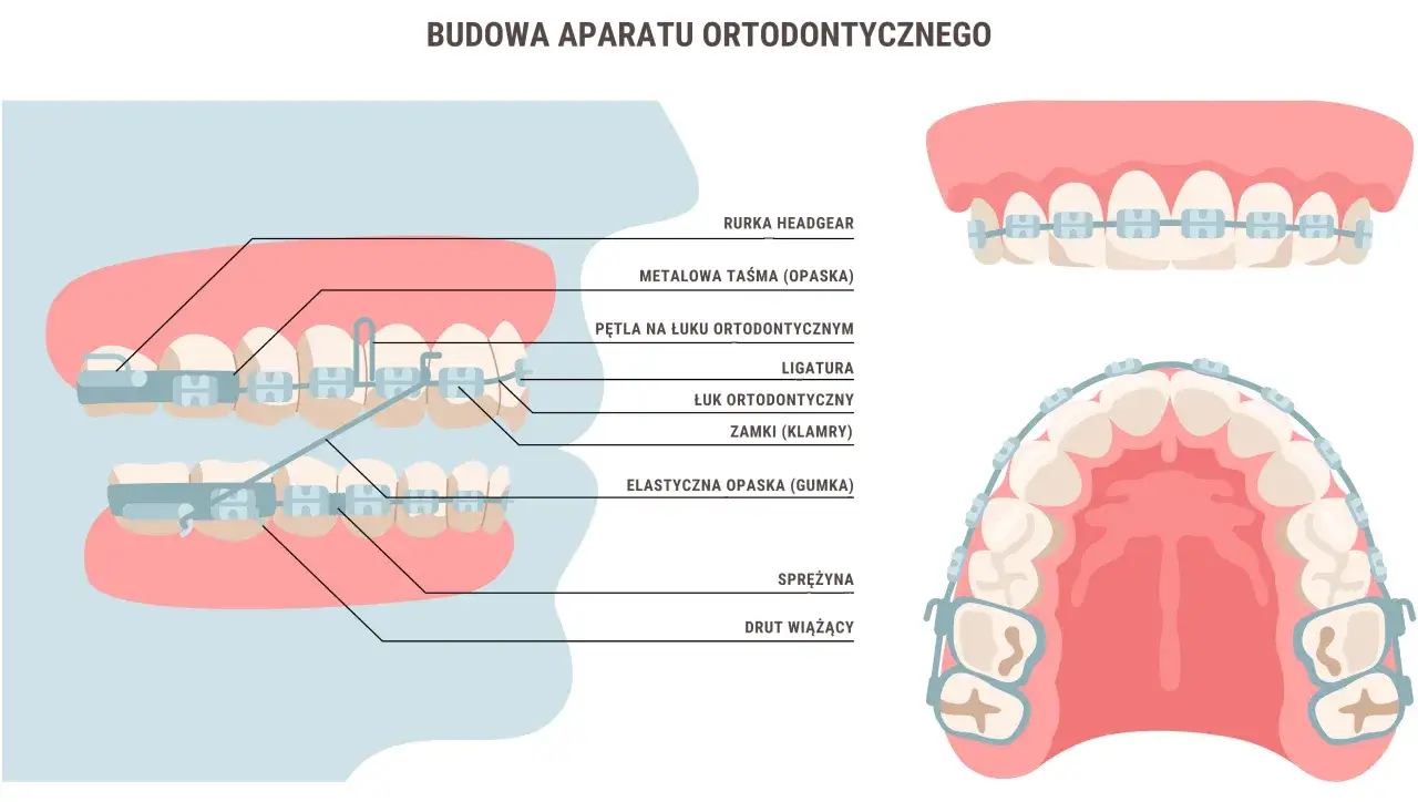 Rysunek schematyczny działania aparatu ortodontycznego