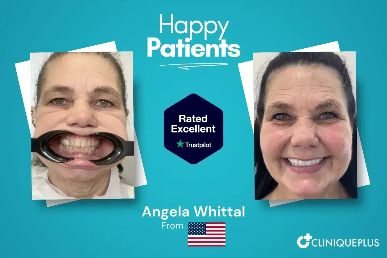 Angela Whittall z USA chwali się nowymi zębami w Turcji. Uśmiech przed i po zabiegu.