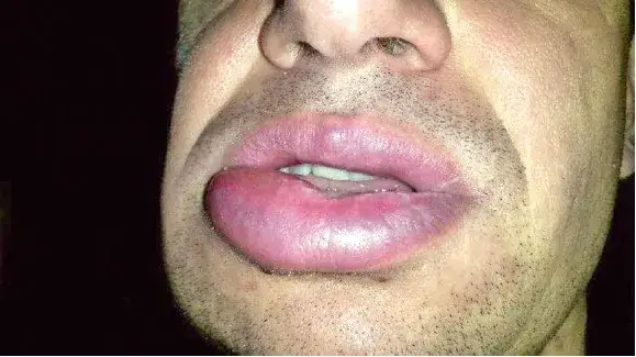 Pacjent po znieczuleniu u dentysty, odrętwiała twarz