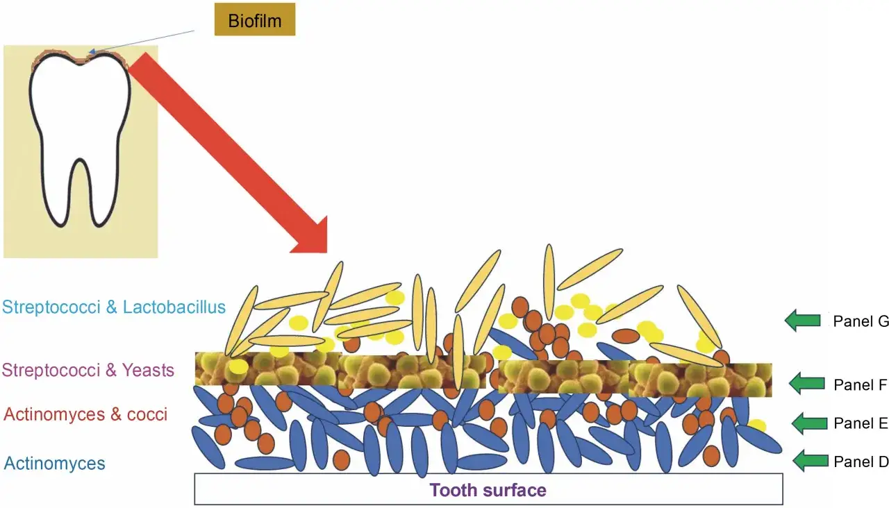 Ilustracja pokazuje warstwy bakterii w jamie ustnej tworzące biofilm na powierzchni zęba. Różne rodzaje bakterii, jak Actinomyces, tworzą złożoną społeczność.