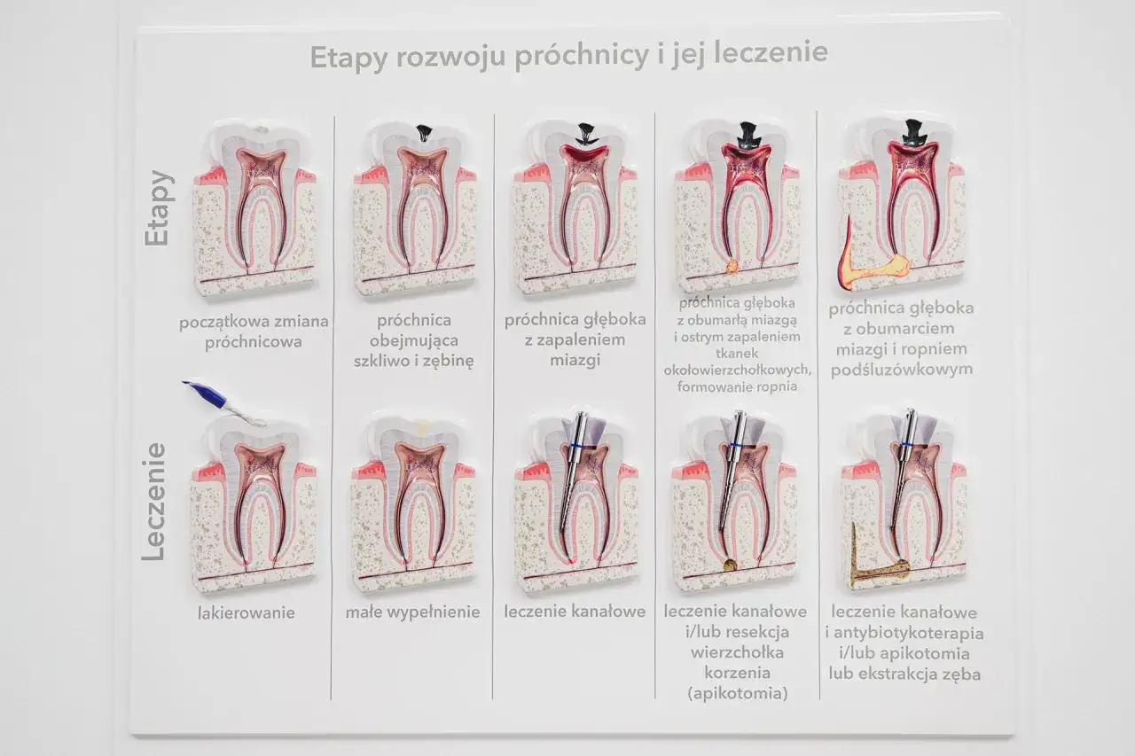 Model pokazuje etapy rozwoju próchnicy, od początkowej zmiany do próchnicy głębokiej z obumarciem miazgi i ropniem. Przedstawiono też metody leczenia.