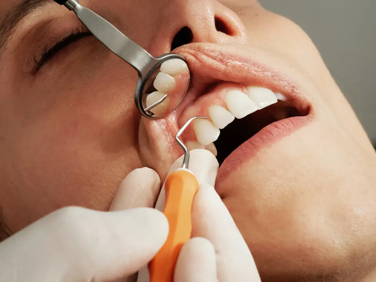 Dentysta bada zęby, widoczne są białe zęby i dziąsła. Narzędzia dentystyczne wskazują na próchnicę zaawansowaną.