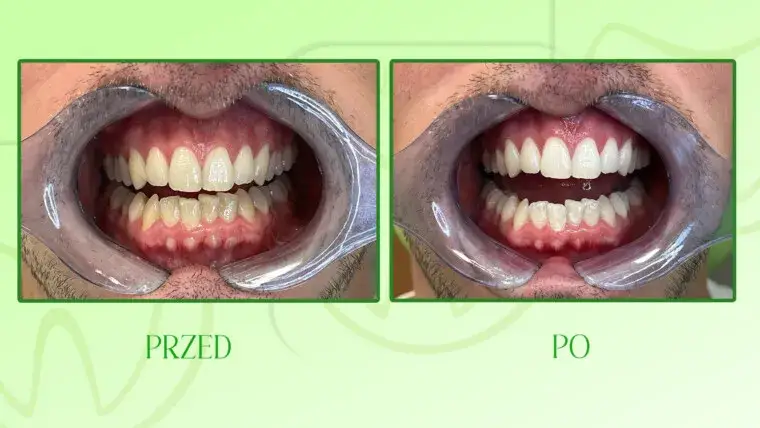 konsultacja stomatologiczna przed wybielaniem