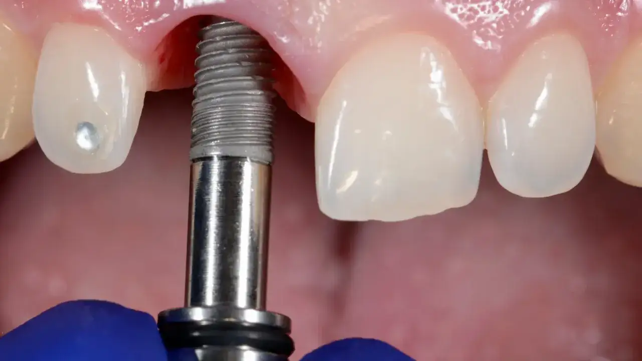 Odbudowa zęba jedynki cena: implant stomatologiczny wkręcany w kość, przygotowanie do założenia korony.