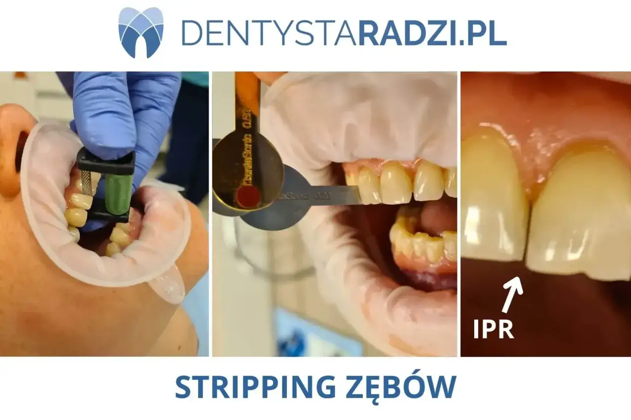 Zabieg stripping zębów, czyli IPR, polega na delikatnym modelowaniu przestrzeni międzyzębowych.