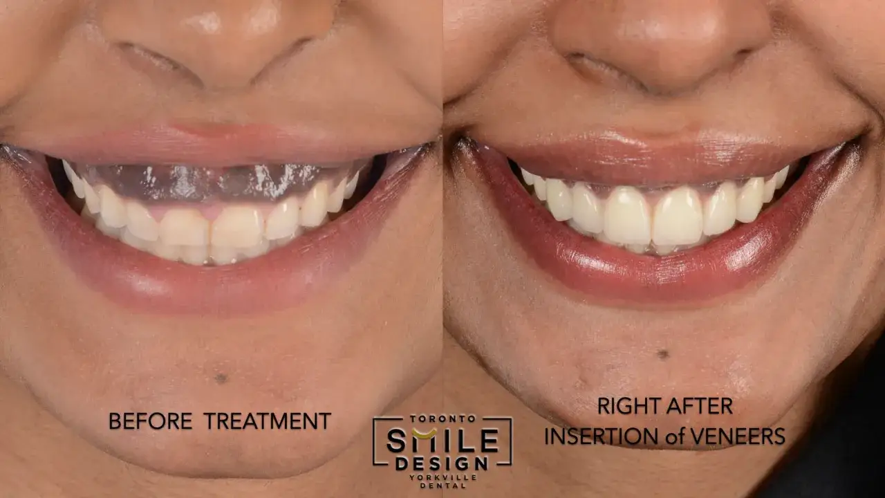 Uśmiech przed i po zabiegu. Po lewej widoczne ciemne dziąsła i nierówne zęby, po prawej piękny, biały uśmiech z licówkami, eliminujący gummy smile.