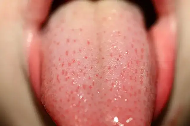 HPV objawy w jamie ustnej, brodawczaki na języku, kłykciny w jamie ustnej