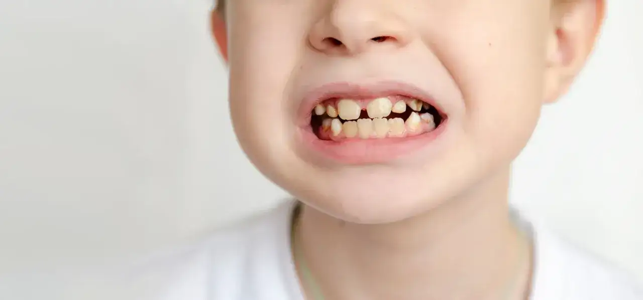 Uśmiech dziecka z widocznymi, żółtymi zębami, niektóre z ubytkami. Może to być sygnał, że czas na wizytę u dentysty, aby zadbać o zdrowie jamy ustnej.
