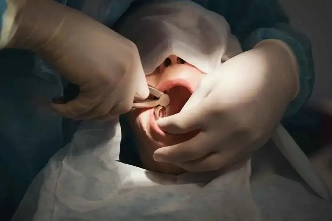 dentysta wykonujący ekstrakcję zęba
