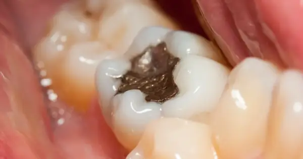 Widok zęba z widoczną, ciemną, metaliczną plombą, otoczoną białymi zębami i różowymi tkankami jamy ustnej.