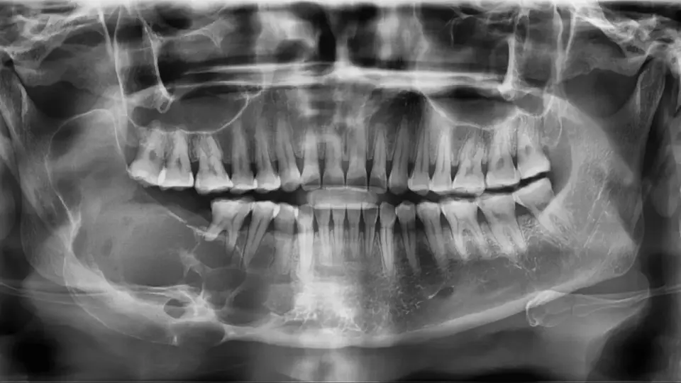 Szkliwiak żuchwy (ameloblastoma) - objawy i leczenie