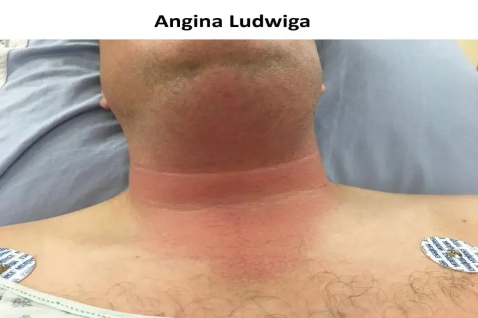 Angina Ludwiga - objawy, przyczyny i leczenie w szpitalu