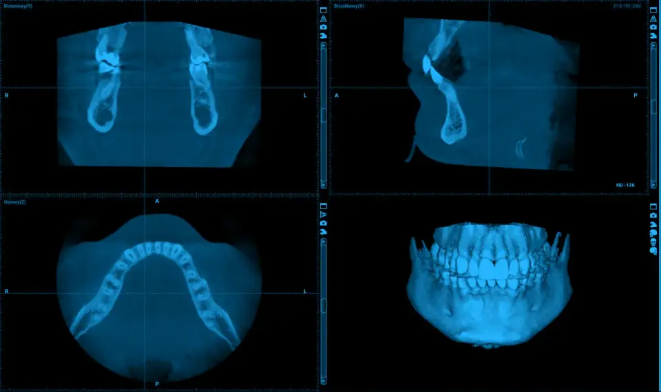 CBCT zębów - kiedy jest potrzebne i ile kosztuje?
